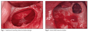 traditional vs Less-Invasive Window Design
