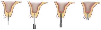 Sequential steps in indirect sinus augmentation technique