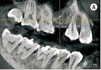 Pre-operative cone-beam computed tomography (CBCT) showing residual subantral bone height of 4.10 mm.