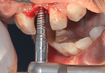 Lateral bone expansion
