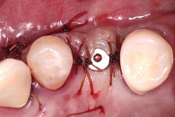 suturing