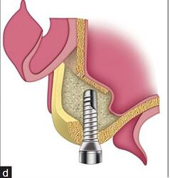Augmented maxillary sinus