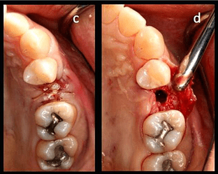atraumatic extraction