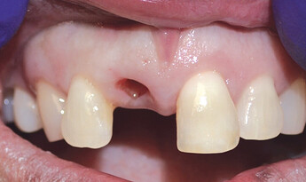 healing abutment was removed and stability was checked