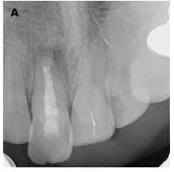 Radiographic view of the right maxillary central tooth with periapical pathology.