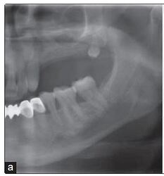 Insufficient residual bone
