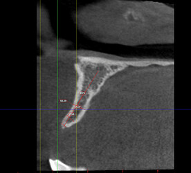 The coronal section of the CBCT