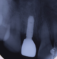 functioning of the prosthesis without bone loss.