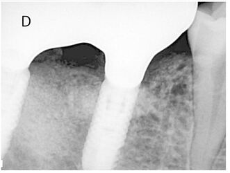 Follow-up radiograph at 12 months after completion of prosthetic restorations