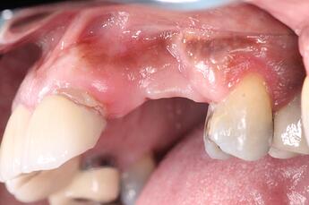 severe resorption