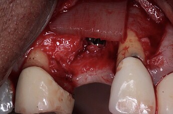 DALI Flex Graft Placement