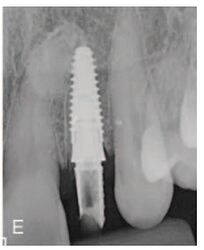 postoperative periapical radiograph