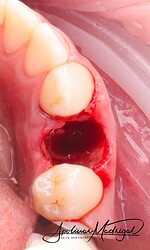 Post-extraction socket