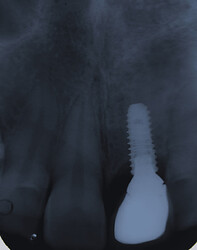 Intra-oral periapical radiograph 1 year