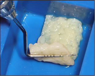 PRF membrane ready to use for ridge preservation