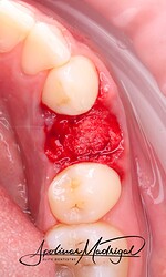 Plug adapted into socket and good blood flow soaked the plug