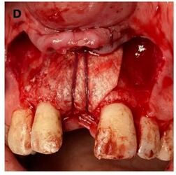 Covering the area with a membrane and securing it with a resorbable suture.