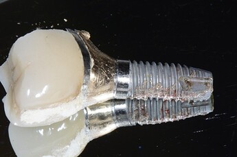implant removed for advanced peri-implantitis
