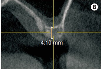 Pre-operative cone-beam computed tomography (CBCT) showing residual subantral bone height of 4.10 mm.