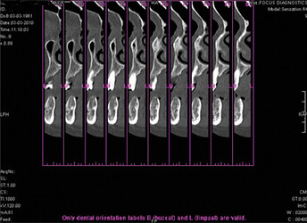 cbct-coronal section