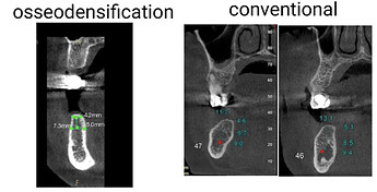 Preoperative cone-beam computed tomography showing narrow alveolar ridge.