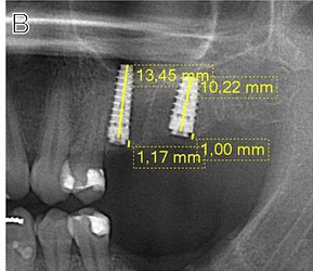 immediate postoperative period