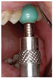 Insertion of the sinus balloon for detachment of the sinus membrane.