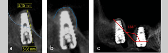 a Measuring the amount of bone gain achieved following the Densah lift. b Graft containment around the implant apex. c Angle measurement confirming a sloping sinus floor