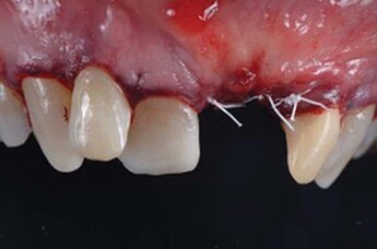suturing