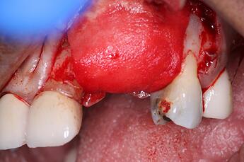 folding osseoseal membrane
