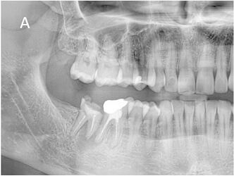 Right mandibular first and second molars with chronic periapical pathology due to unsuccessful endodontic treatments