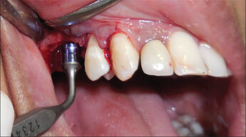 The use of the depth gauge with safe end for assessing the osteotomy depth, confirming perforation of the sinus floor