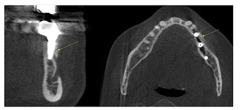 CBCT, 2 years after the restoration