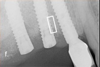 radiograph 11 months after surgery