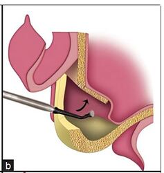 Lateral wall of sinus in-fractured