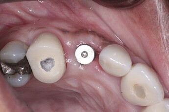 post op obvious increase in the facial contour