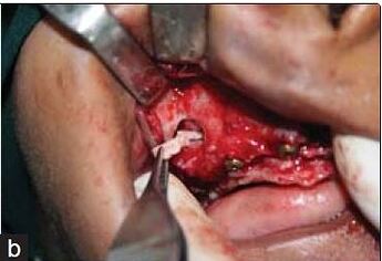 autogenous bone