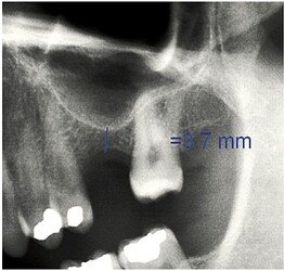 Preoperative panoramic X-ray view.