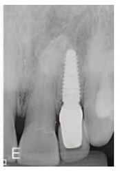 1- year radiographic