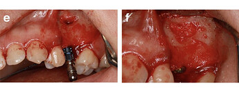 An implant was placed immediately