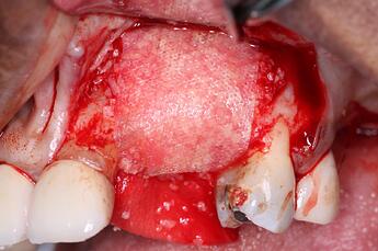 placement of DALI Amnion/Chorion Membrane