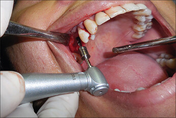 Osteotomy preparation using the drill with stopper attached