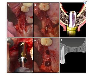 Sinus floor preparation. (a ) performing H incision on teeth 16 and 17. (b ) drill preparation. (c ) Crestal Approach Sinus Kit (CAS) drill simulation. (d ) using CAS drill for preparation. (e ) integrated membrane after CAS drill preparation. (f ) schematic diagram after drill preparation.
