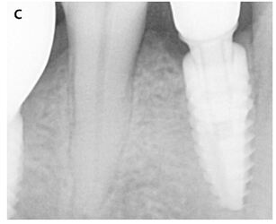 Periapical radiography after completion of prosthetic restoration.