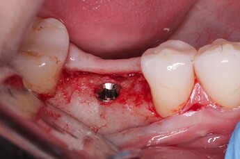 bone thickness is adequate