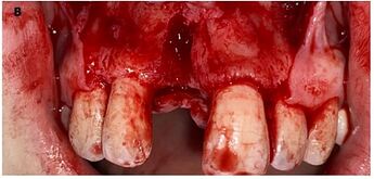 Extraction socket after tooth extraction and curettage of periapical lesions.