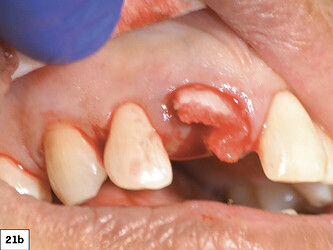 osteogen strips placed in the socket against the wall