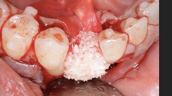 membrane tucked under lingual and graft material added
