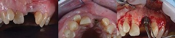 Surgical exposure of the peri-implant site.