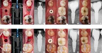 Clinical and radiographic sequence of implant placement and restoration over 12‐month follow‐up.